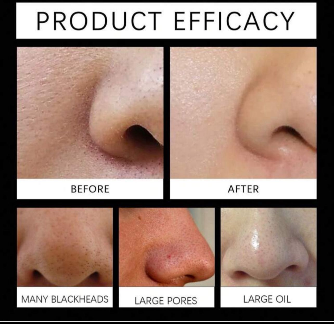 شرائط تنظيف الأنف بالفحم – 24 قطعة لإزالة الرؤوس السوداء وشد المسام